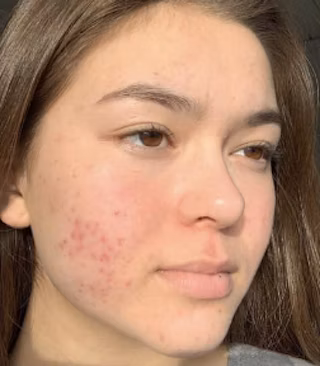 BTBS Hyperpigmented Skin Regimen Page | B+A Tile 1 Image File [Before]